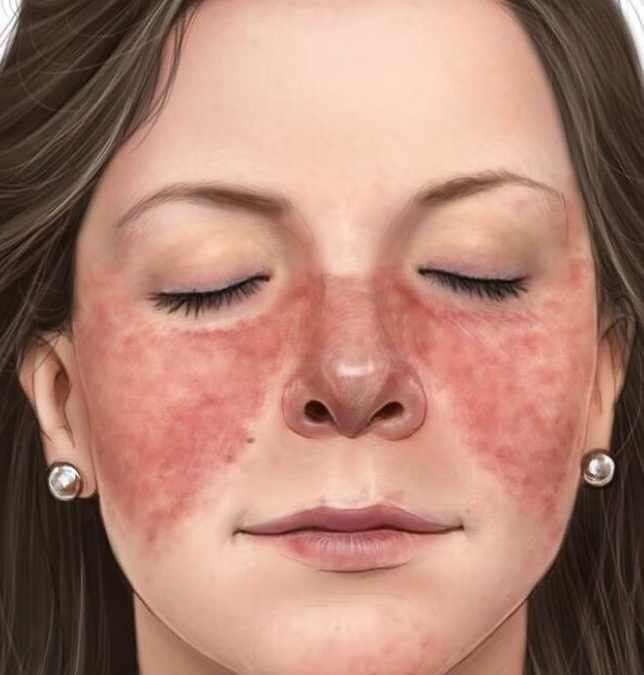 El misterio del lupus que desaparece con la edad: la ciencia por fin lo descifra